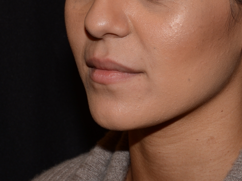 Before Image: Lip Filler - left-front-oblique
