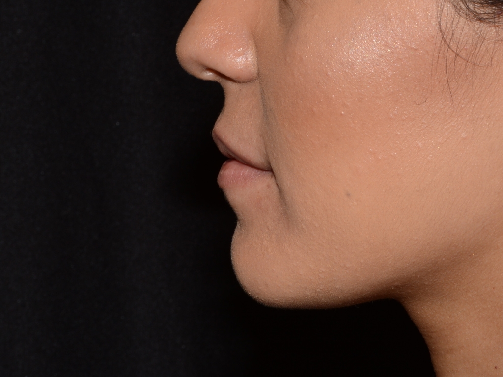 Before Image: Lip Filler - left-side