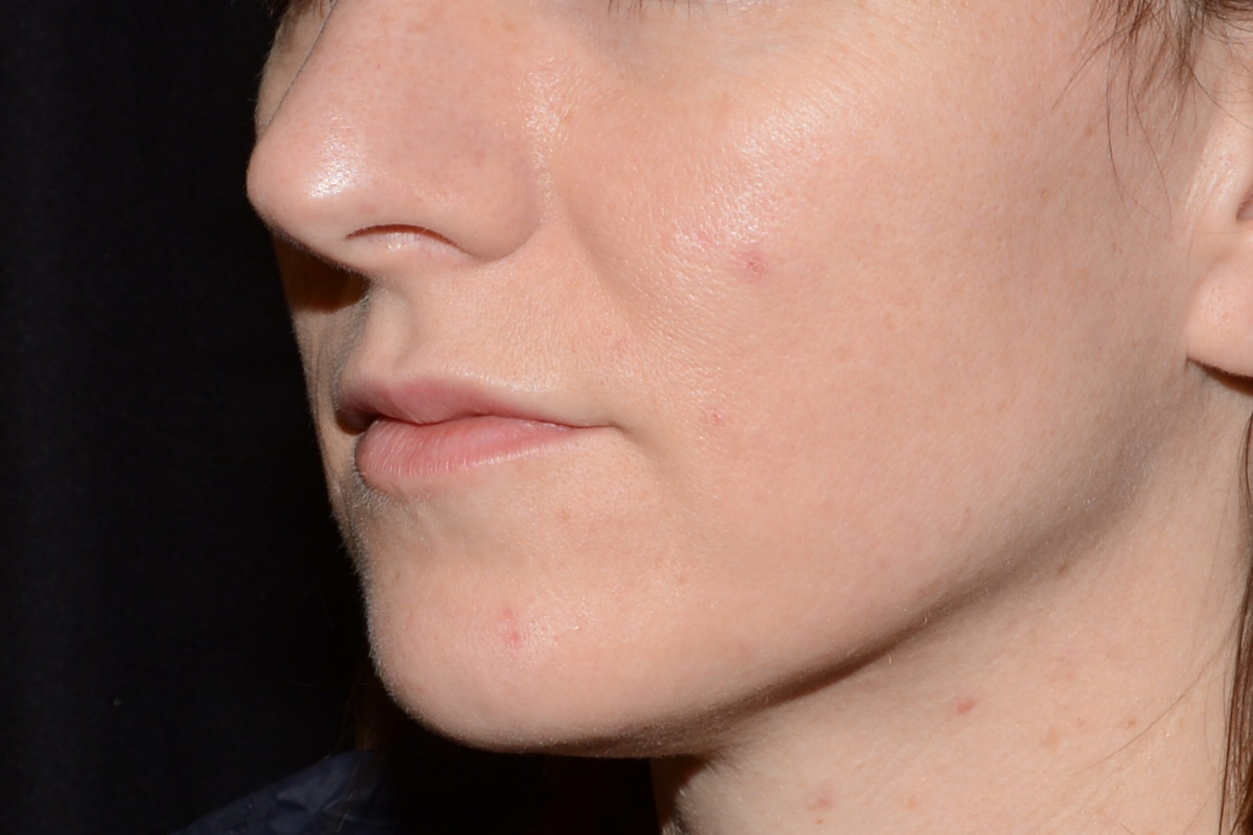After Image: Lip Filler - left-front-oblique