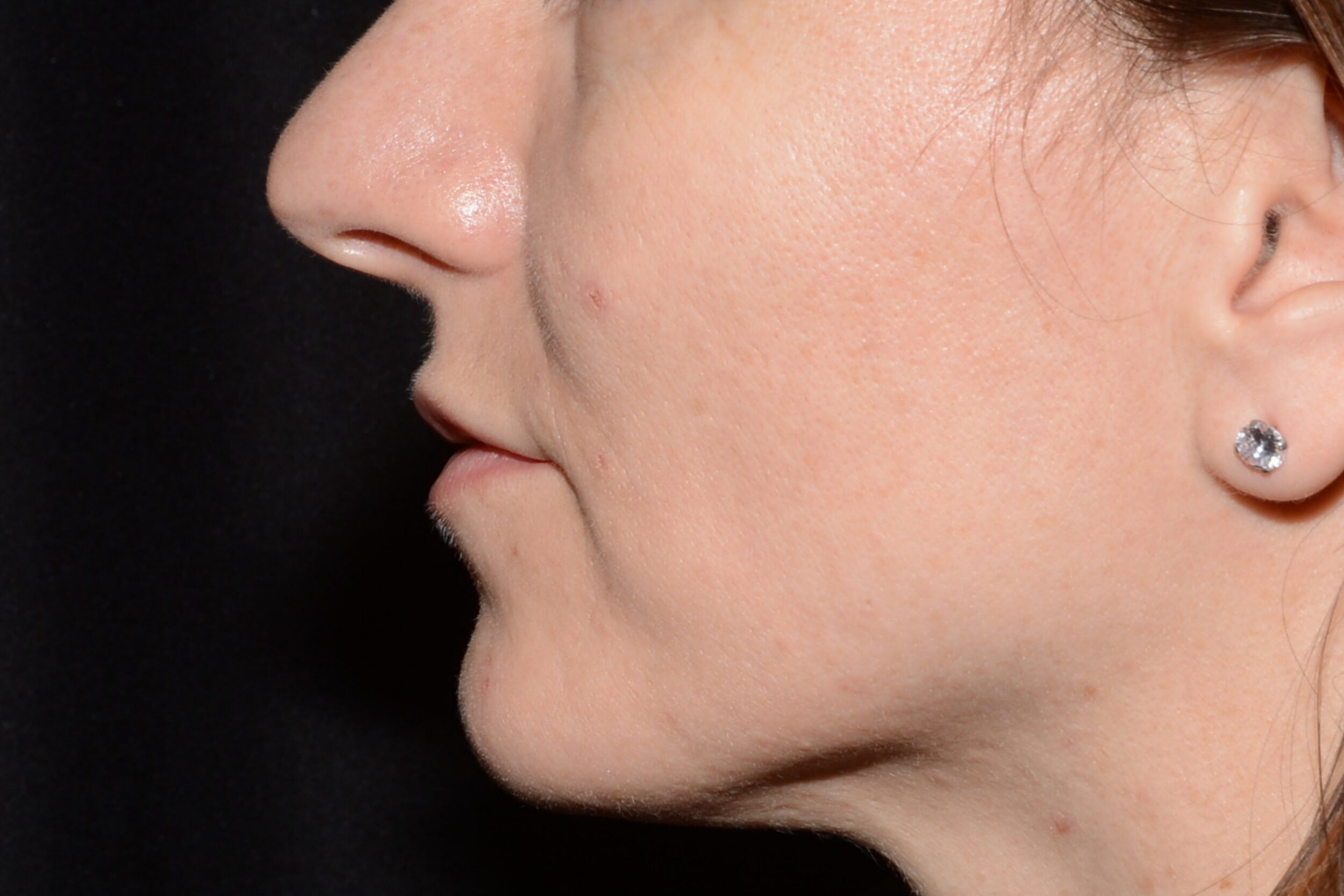 After Image: Lip Filler - left-side