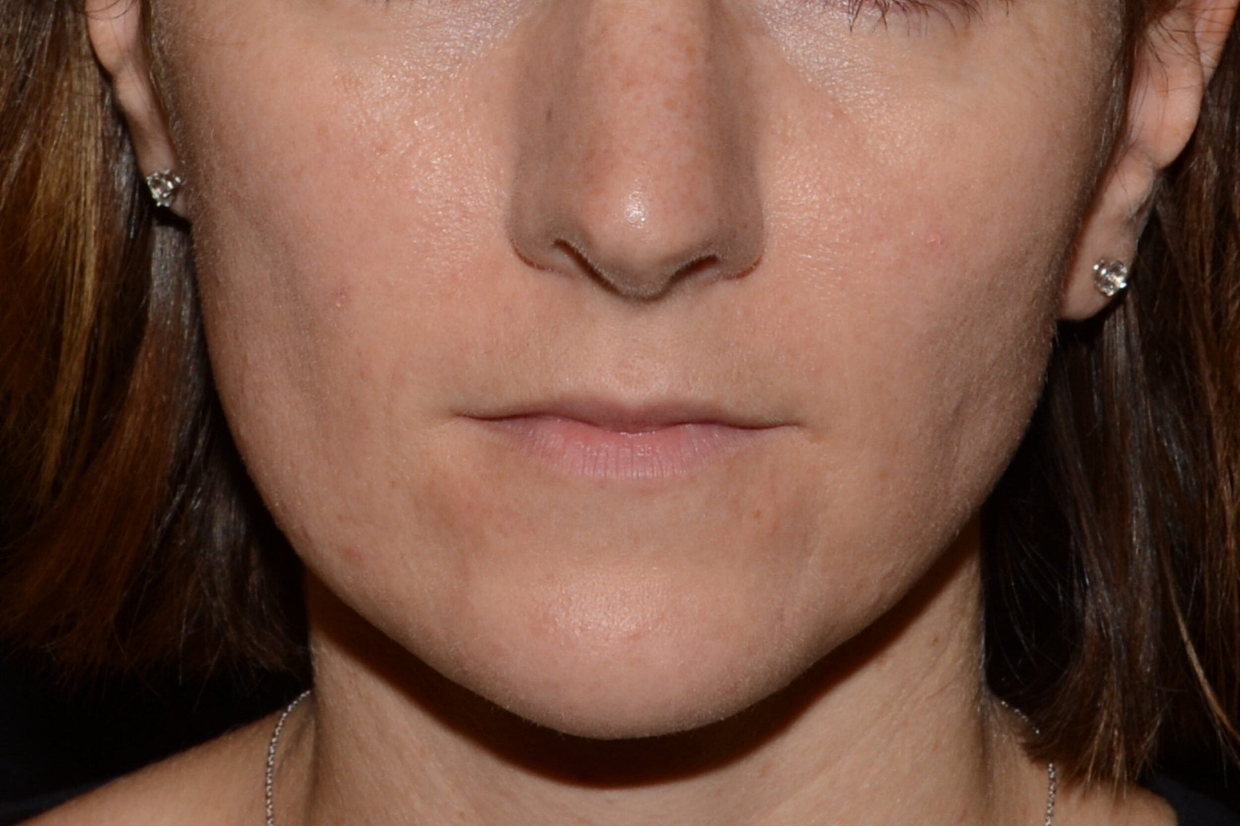 Before Image: Lip Filler - front