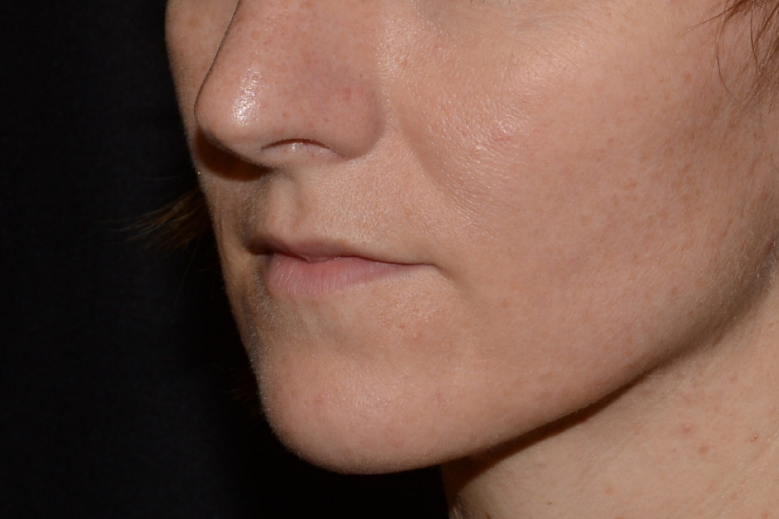 Before Image: Lip Filler - left-front-oblique