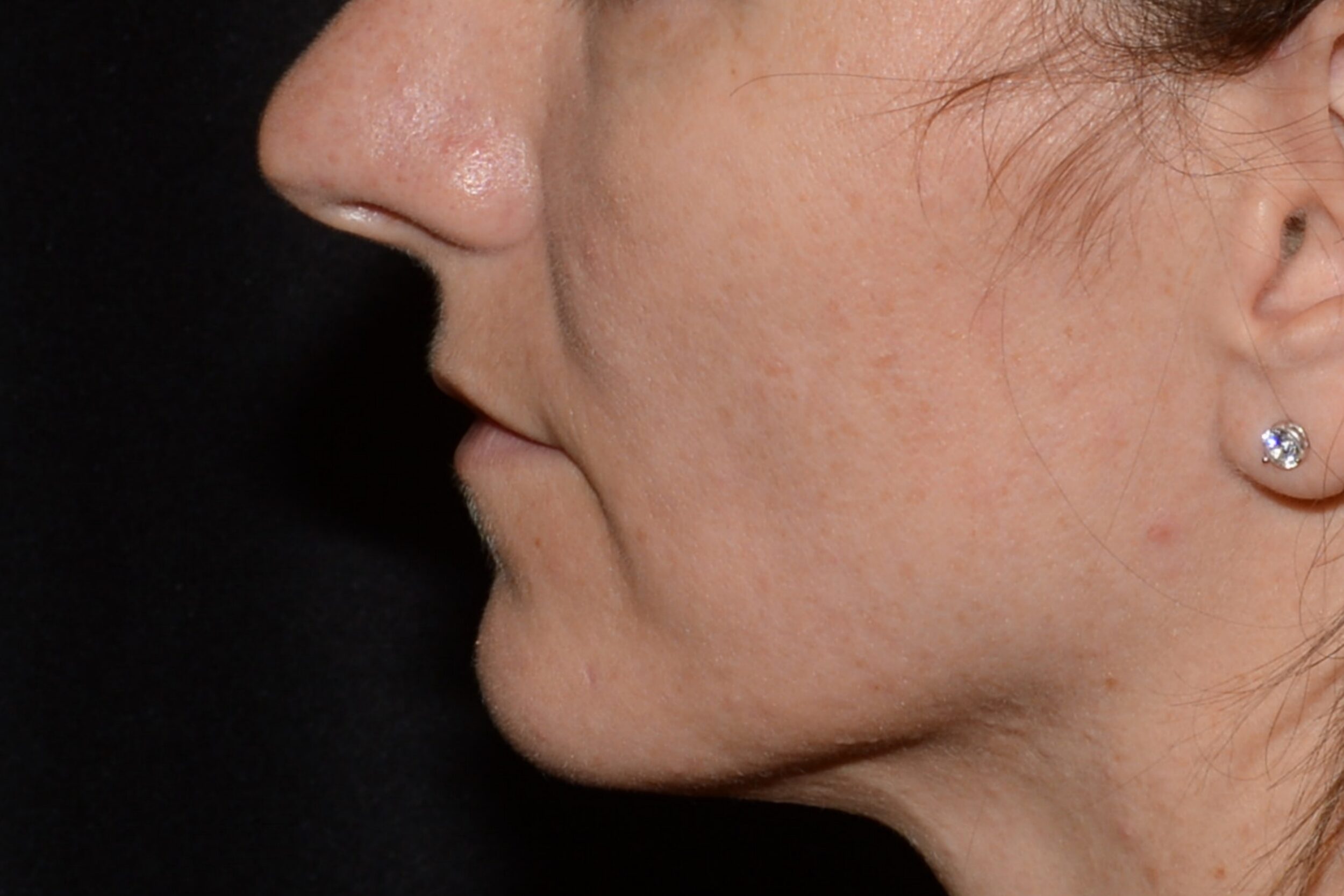 Before Image: Lip Filler - left-side