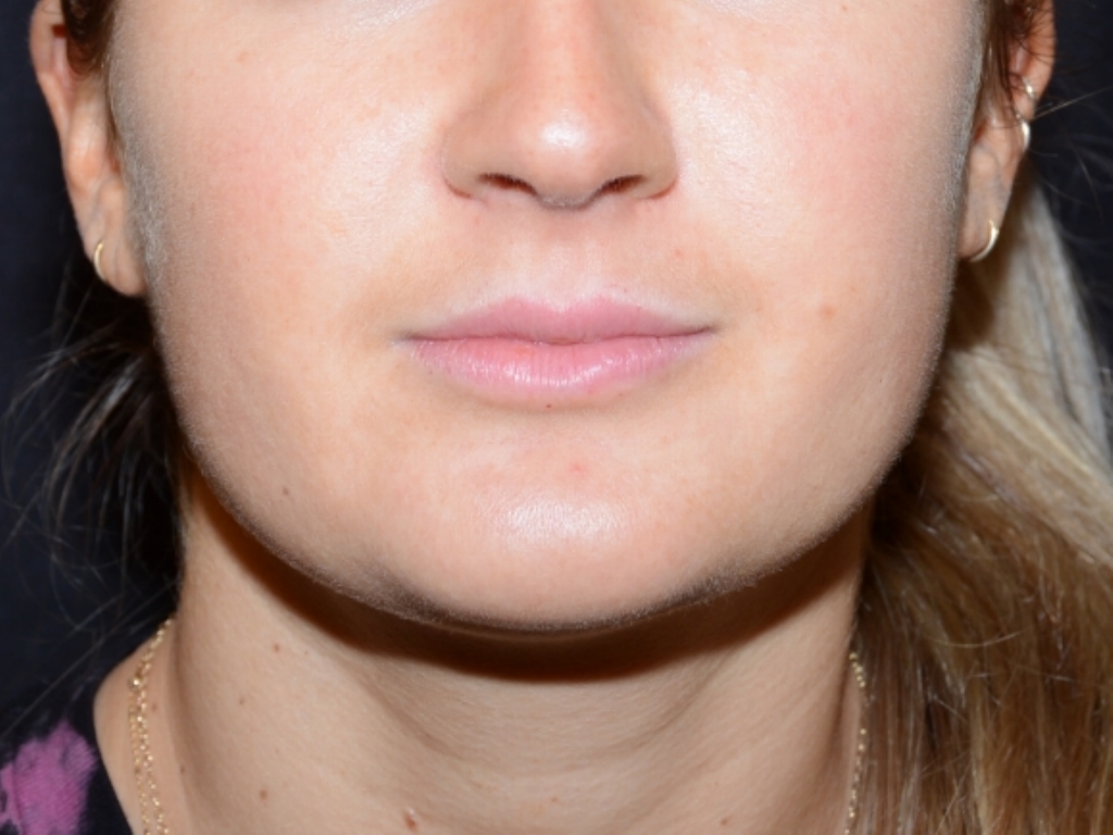 After Image: Lip Filler - front
