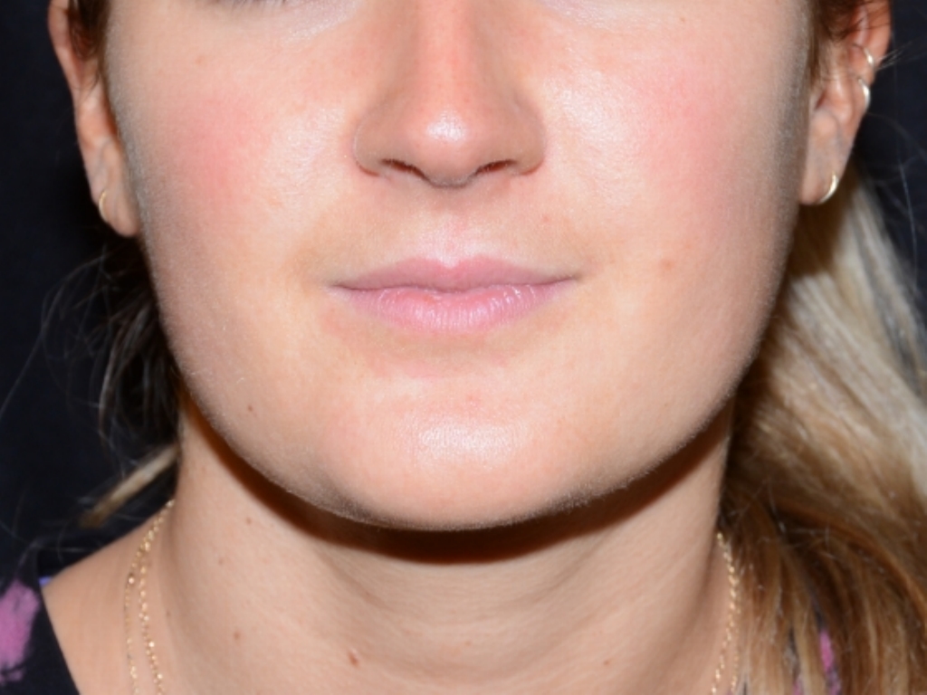 Before Image: Lip Filler - front