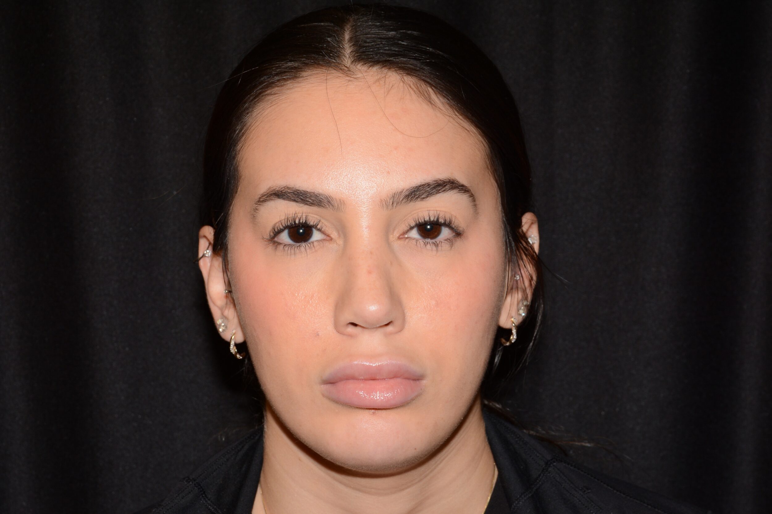 After Image: Chin Augmentation - front