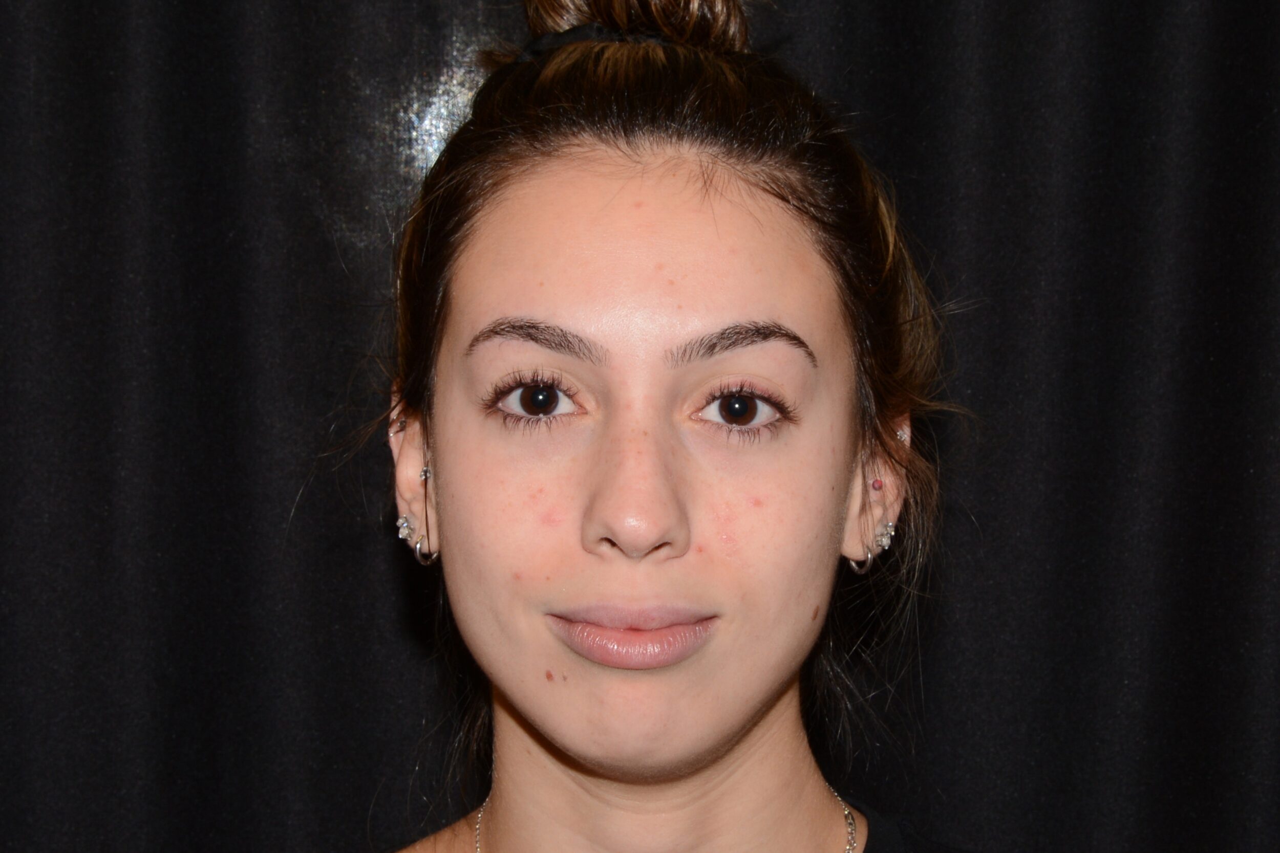 Before Image: Chin Augmentation - front