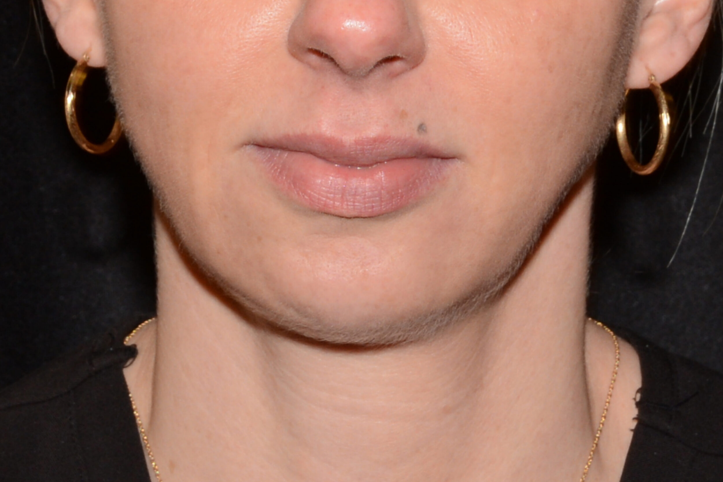 Before Image: Chin Smoothing - front