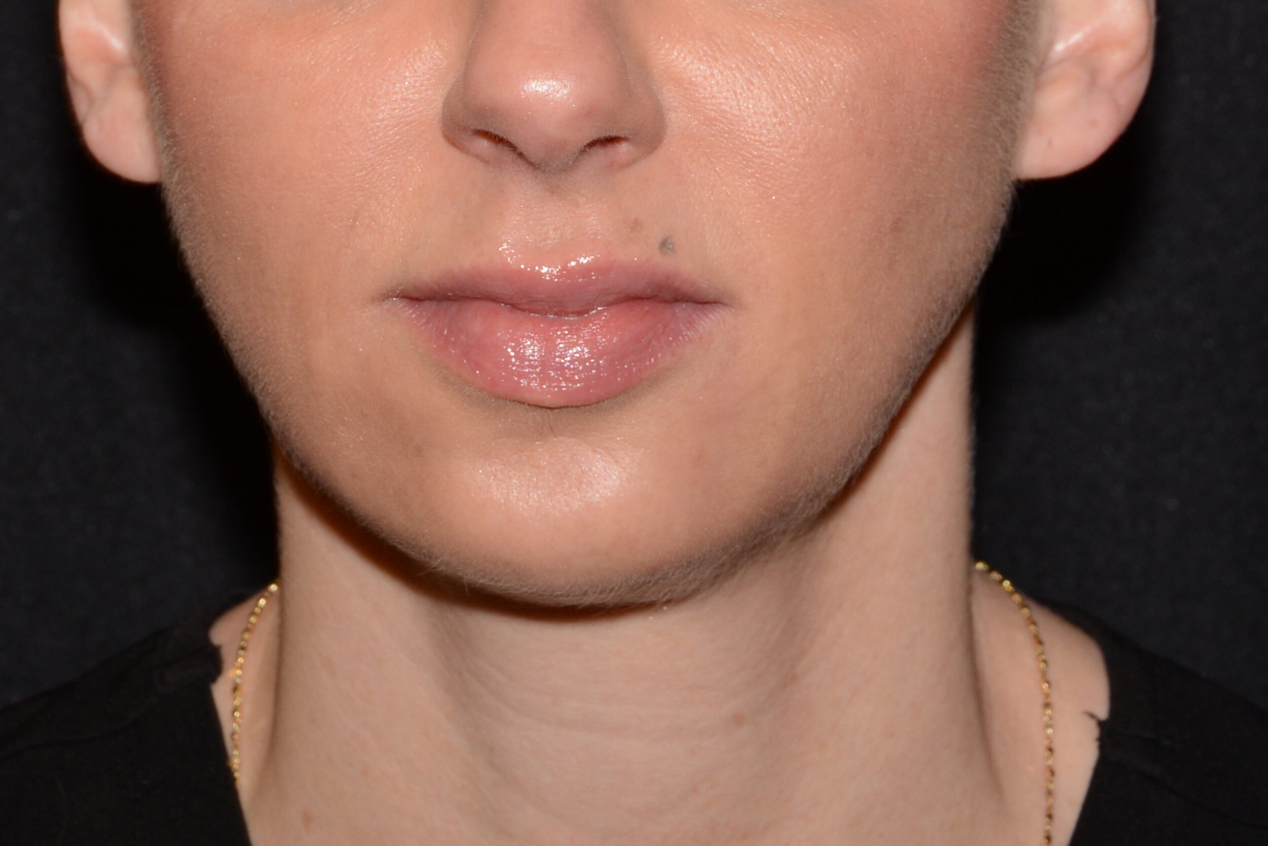 After Image: Chin Smoothing - front