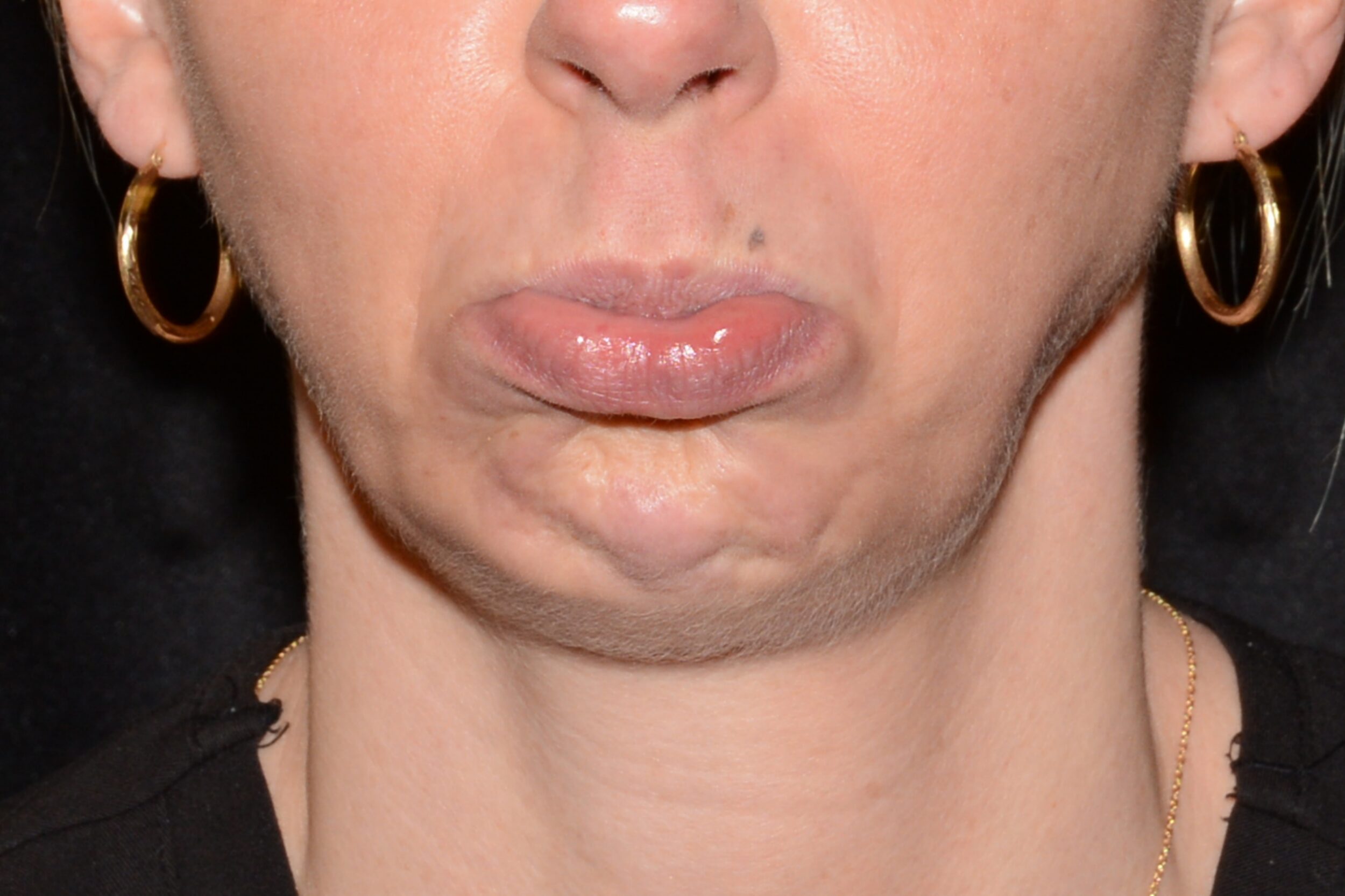 Before Image: Chin Smoothing - front