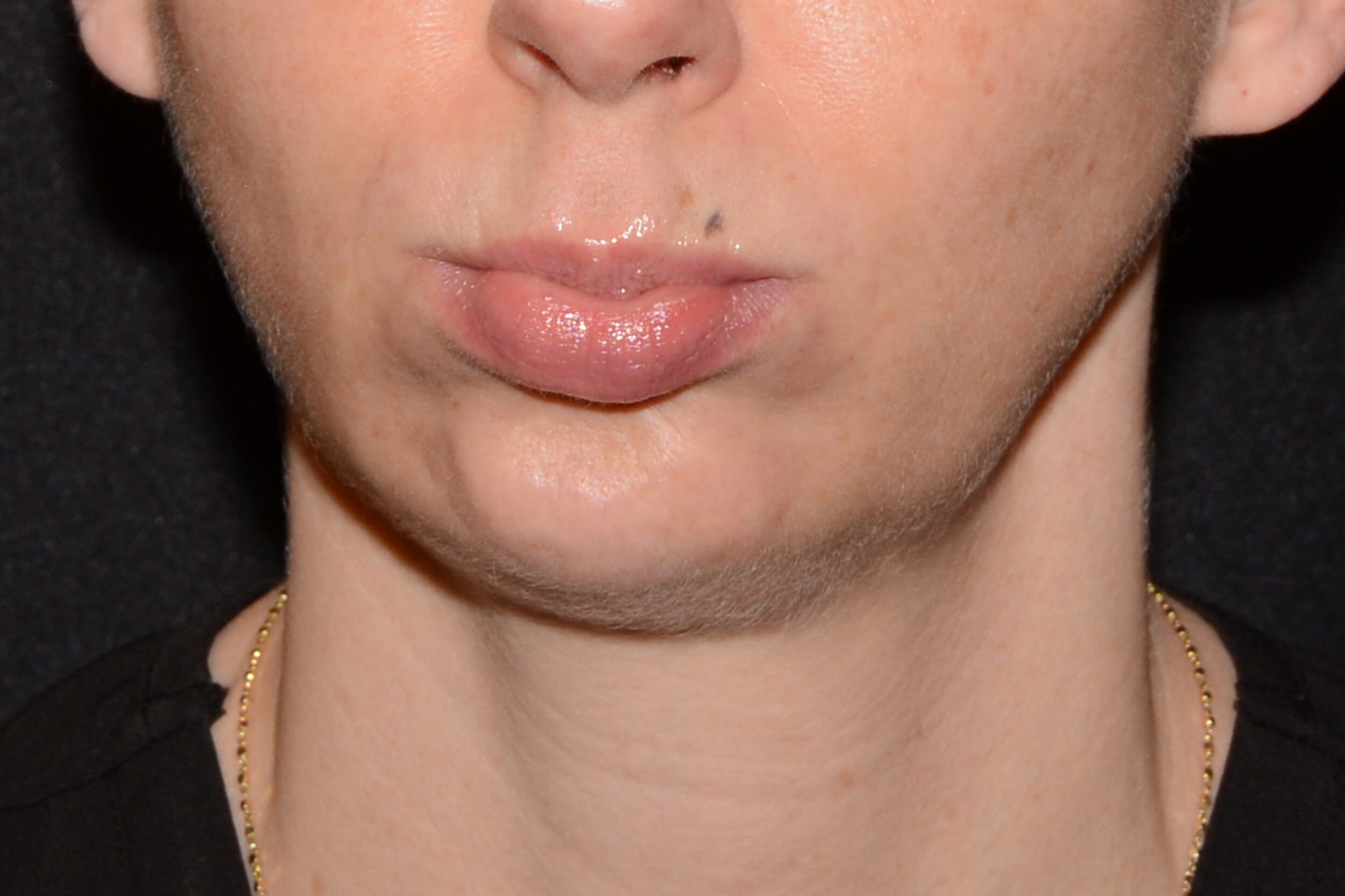 After Image: Chin Smoothing - front