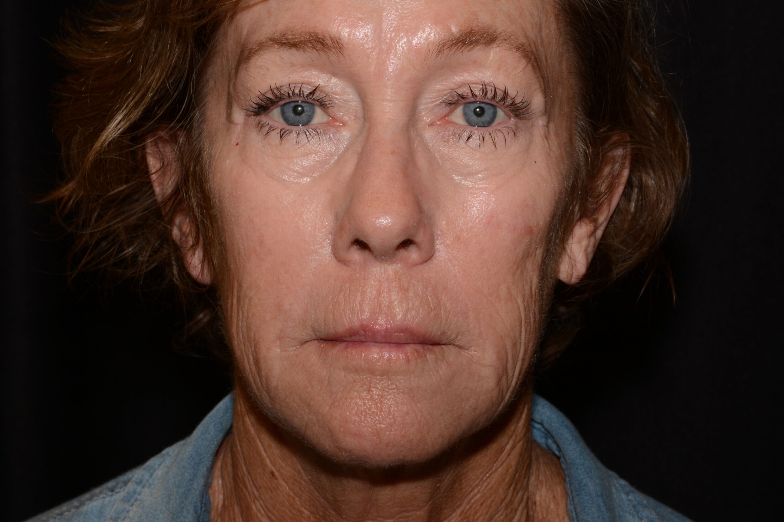 After Image: Facial Balance - front