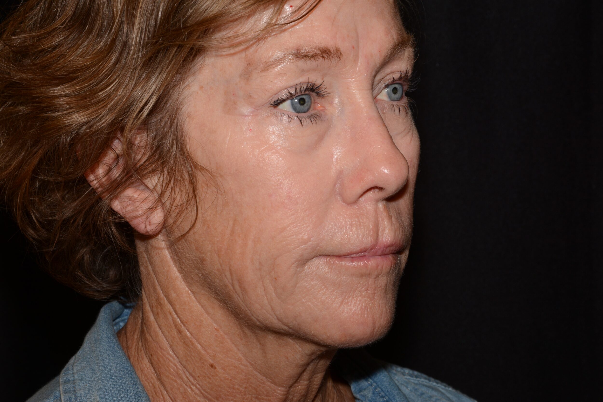 After Image: Facial Balance - right-front-oblique