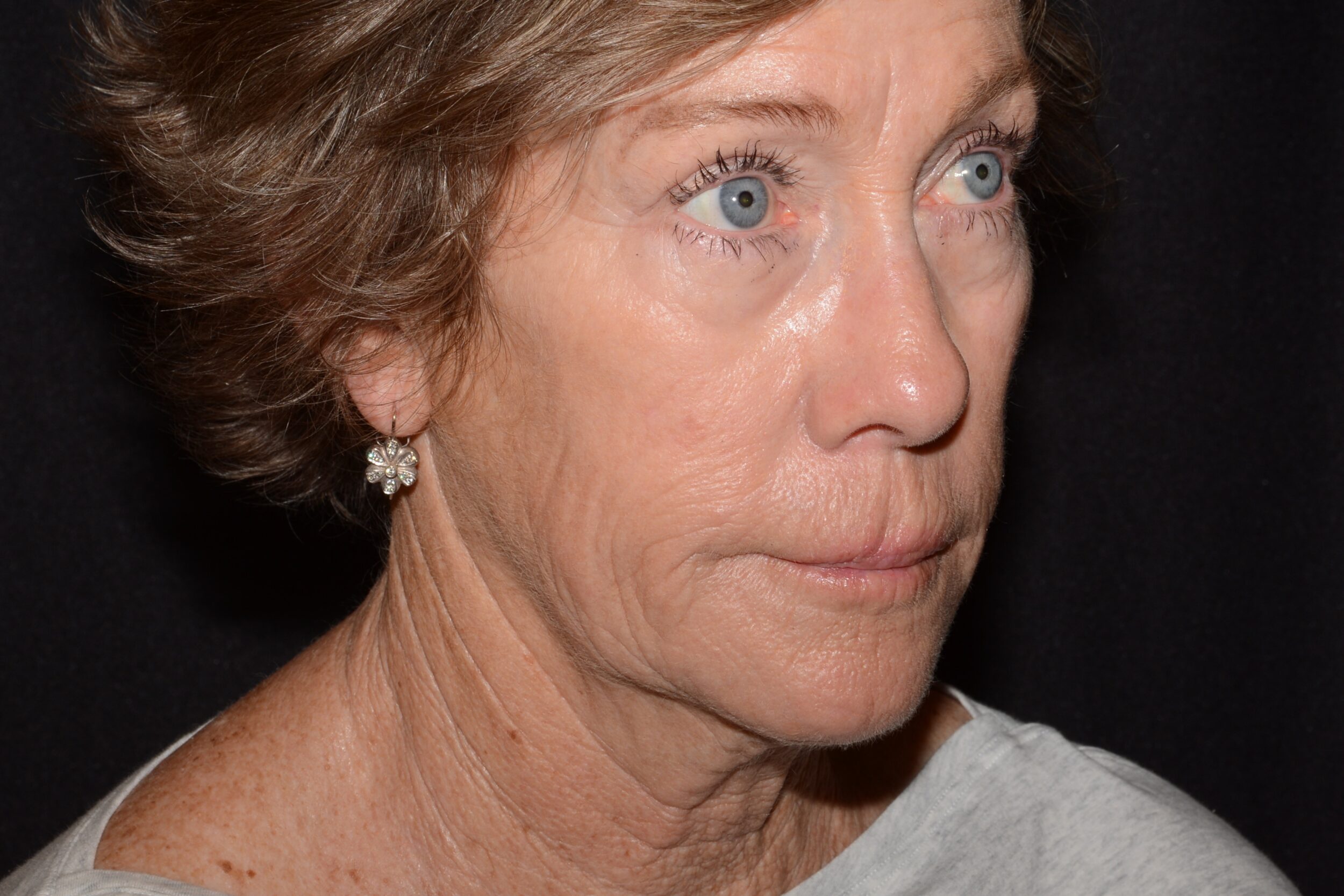 Before Image: Facial Balance - right-front-oblique