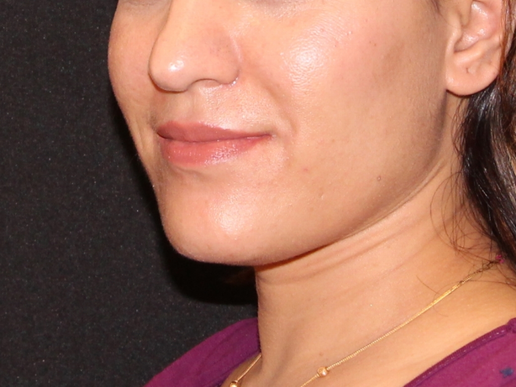 Before Image: Facial Balance - left-front-oblique