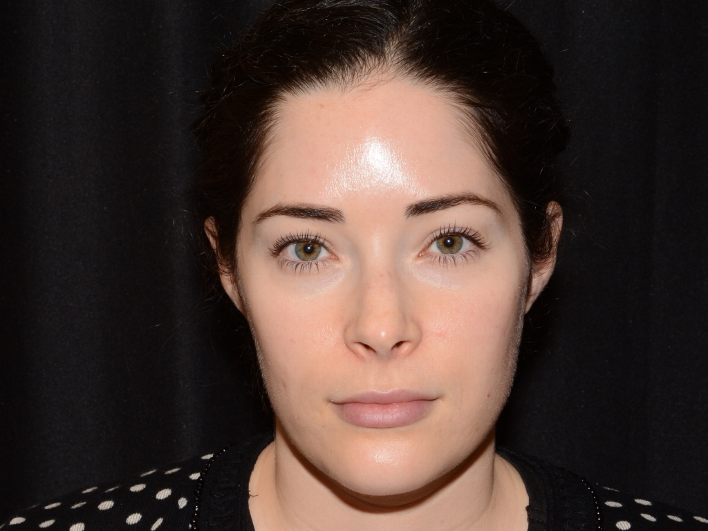 After Image: Facial Balance - front