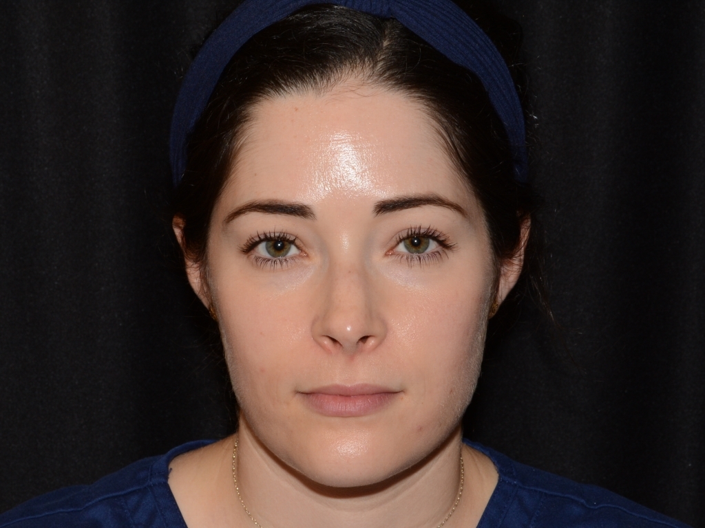 Before Image: Facial Balance - front