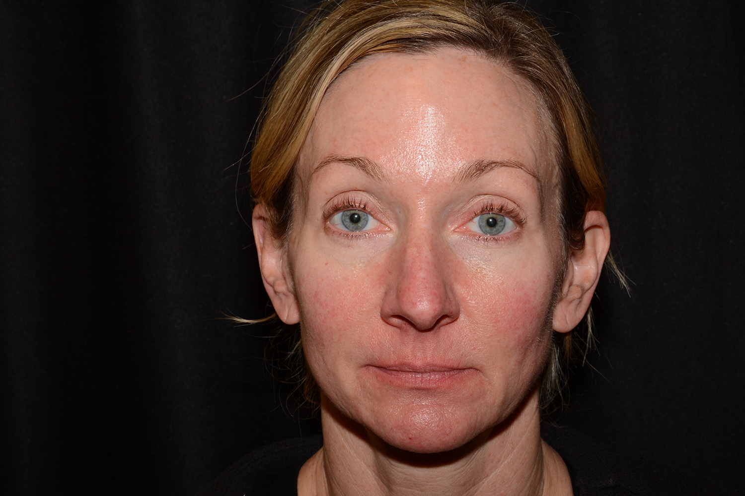 After Image: Jaw Line Filler - front