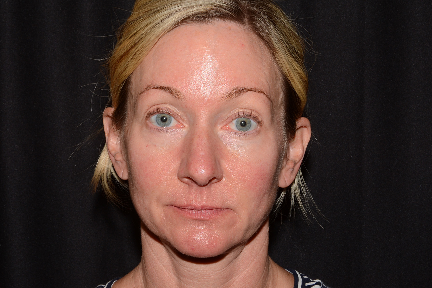 Before Image: Jaw Line Filler - front