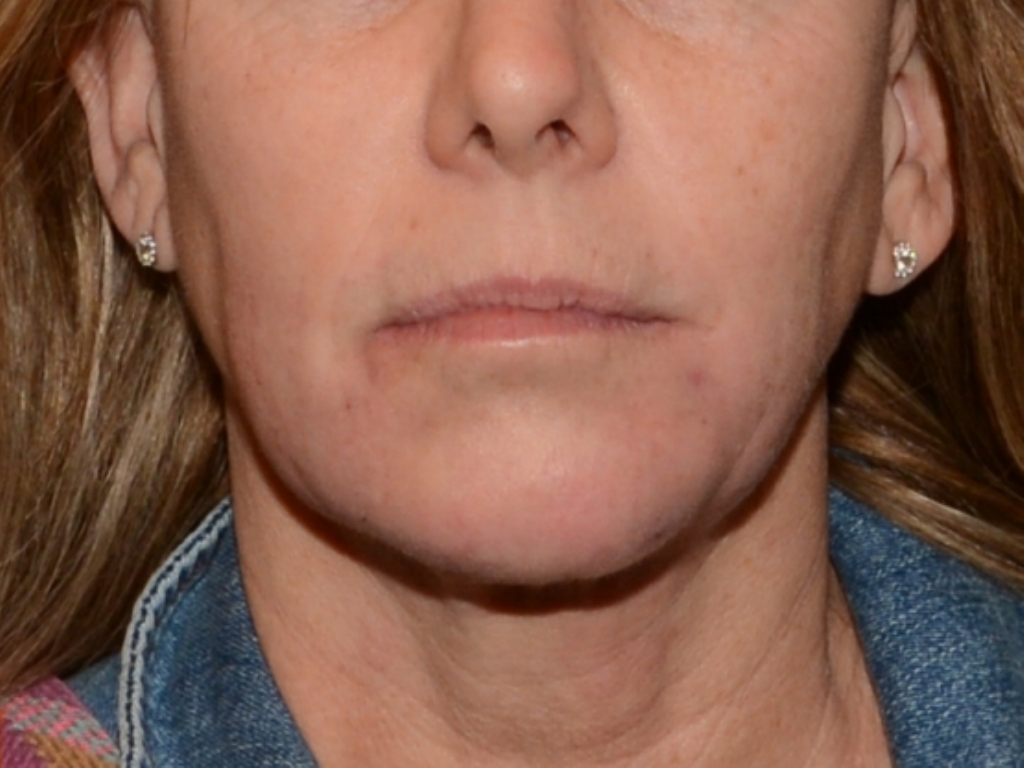 After Image: Jaw Line Filler - front