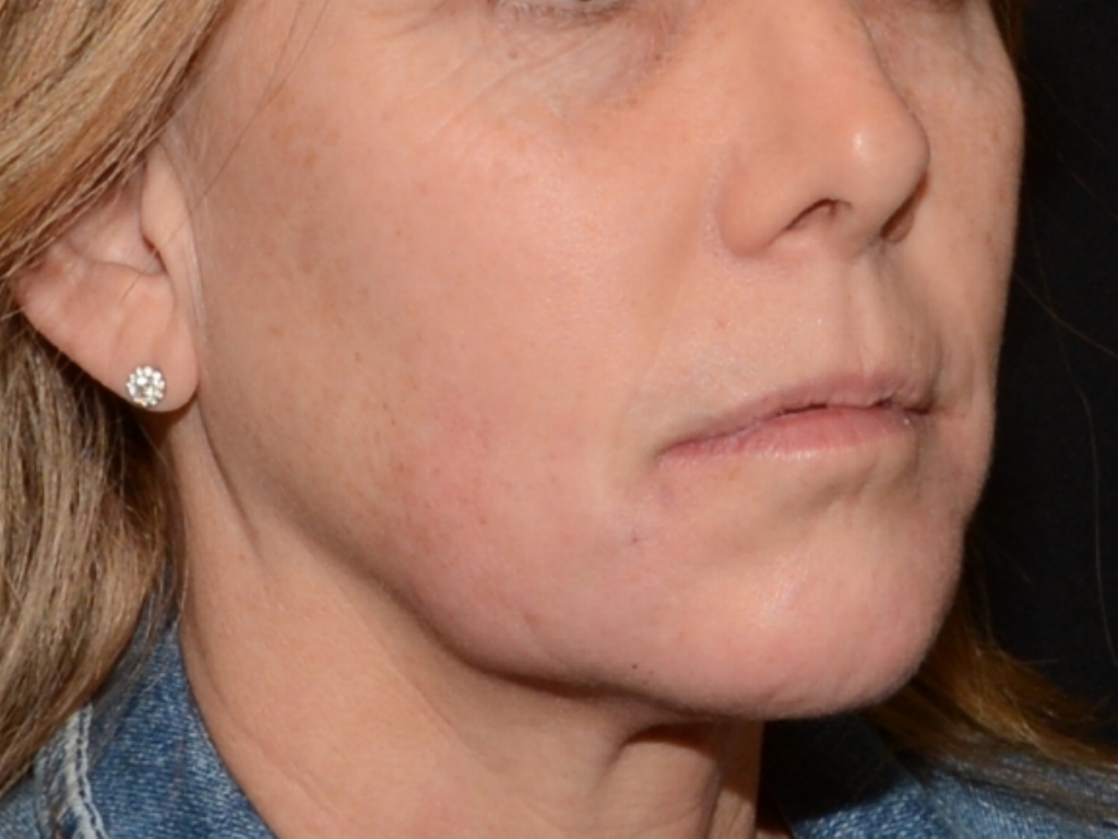 After Image: Jaw Line Filler - right-front-oblique