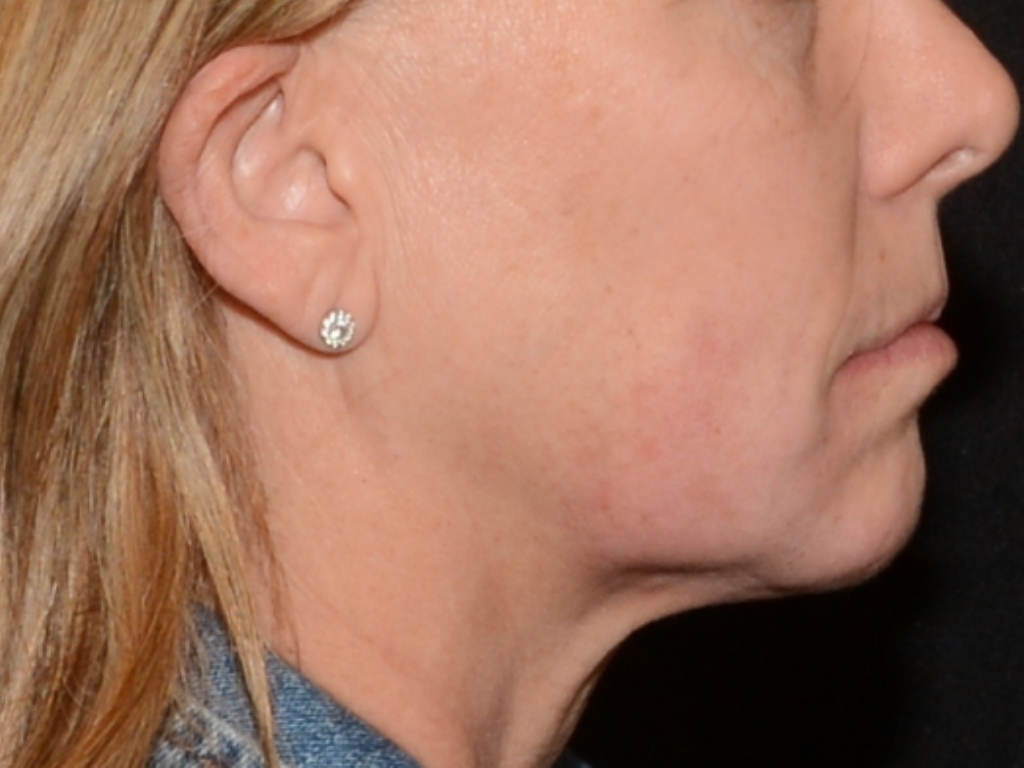 After Image: Jaw Line Filler - right-side