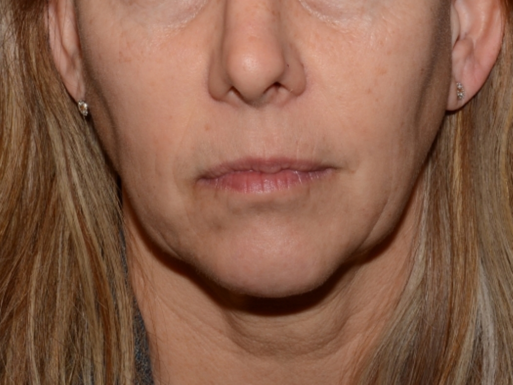 Before Image: Jaw Line Filler - front