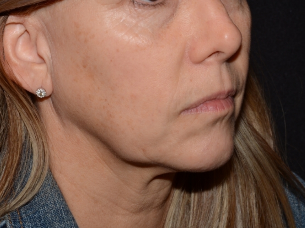 Before Image: Jaw Line Filler - right-front-oblique
