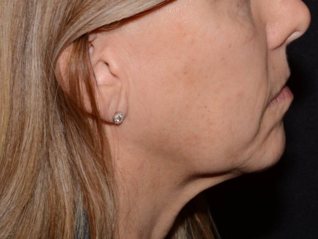 Before Image: Jaw Line Filler - right-side