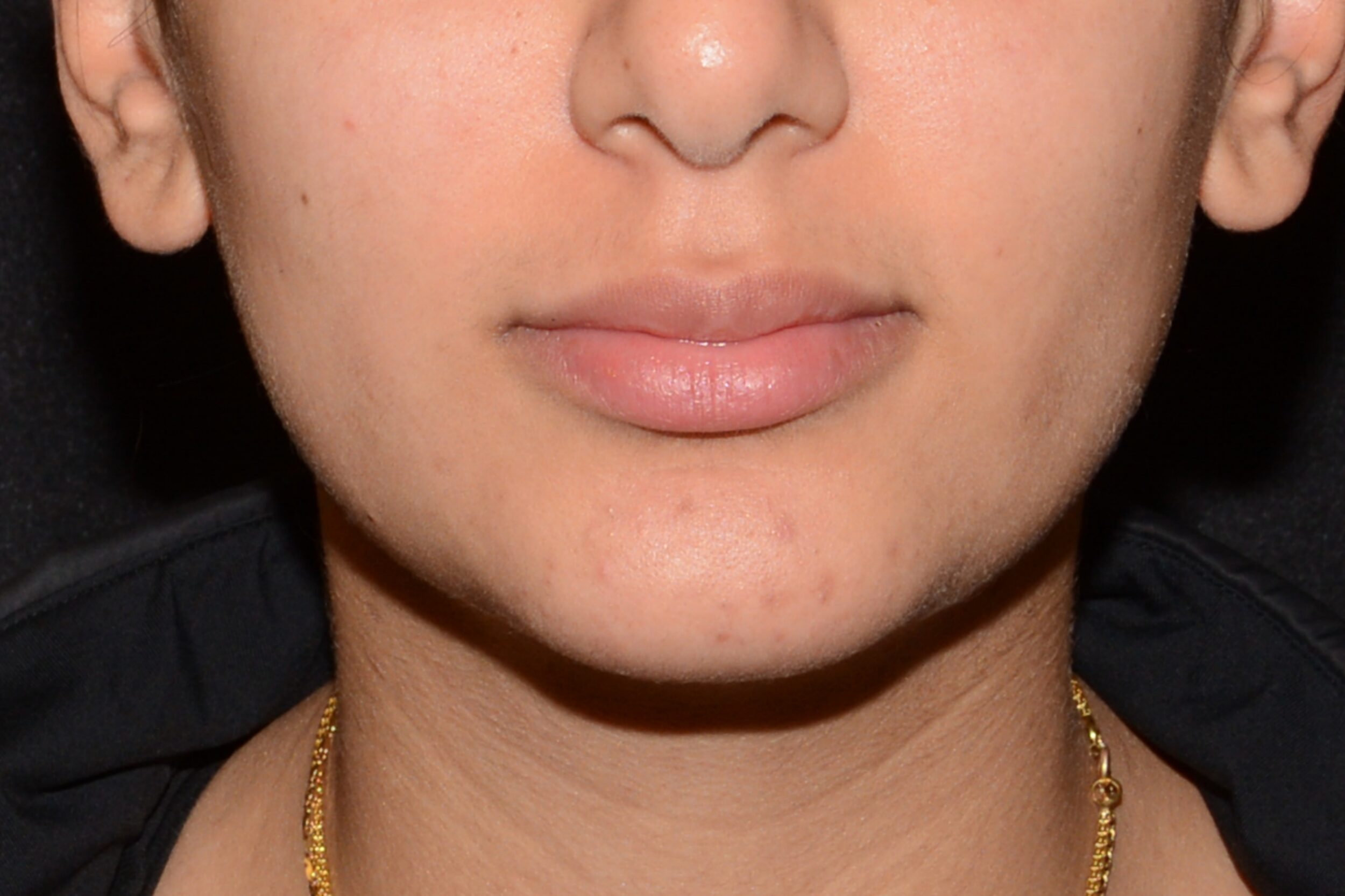 After Image: Lip Flip - front