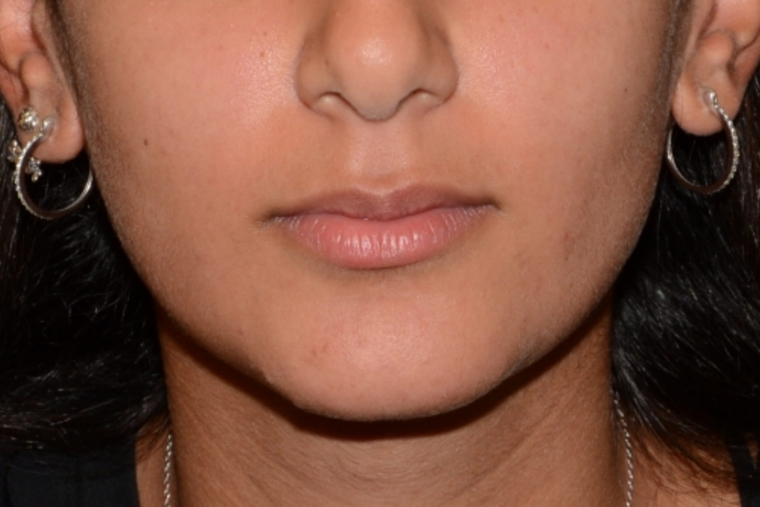 Before Image: Lip Flip - front