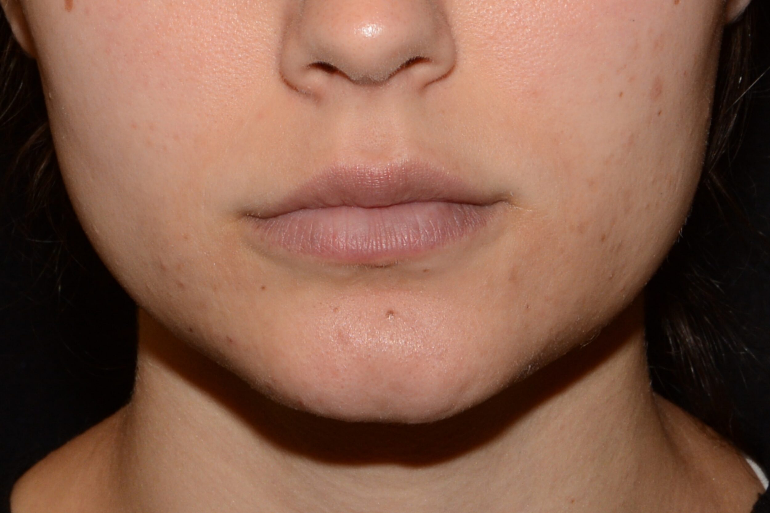 After Image: Lip Flip - front