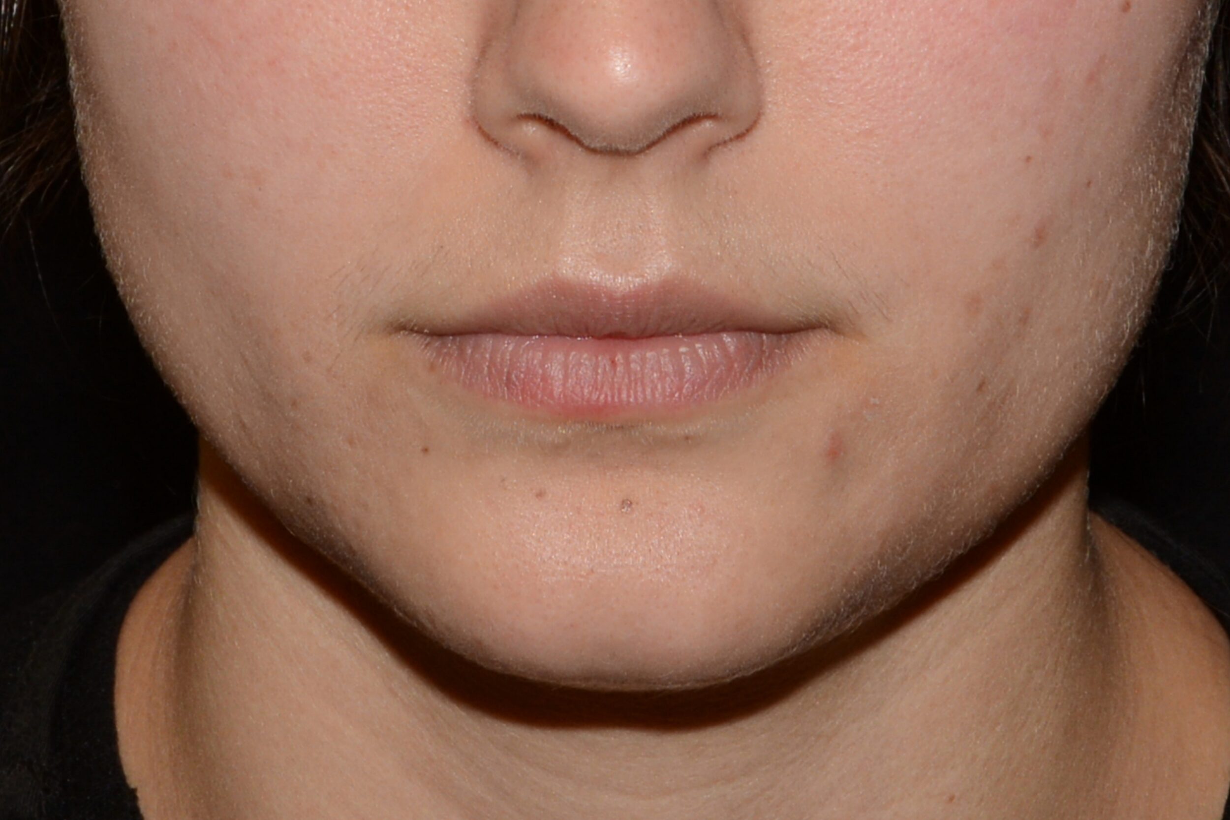 Before Image: Lip Flip - front