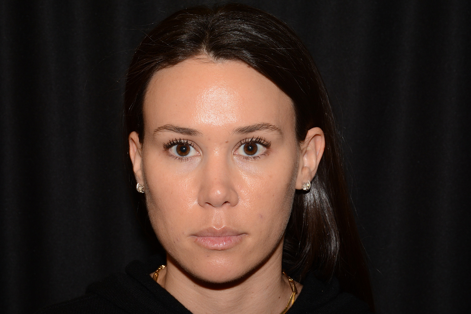 After Image: Facial Balance - front