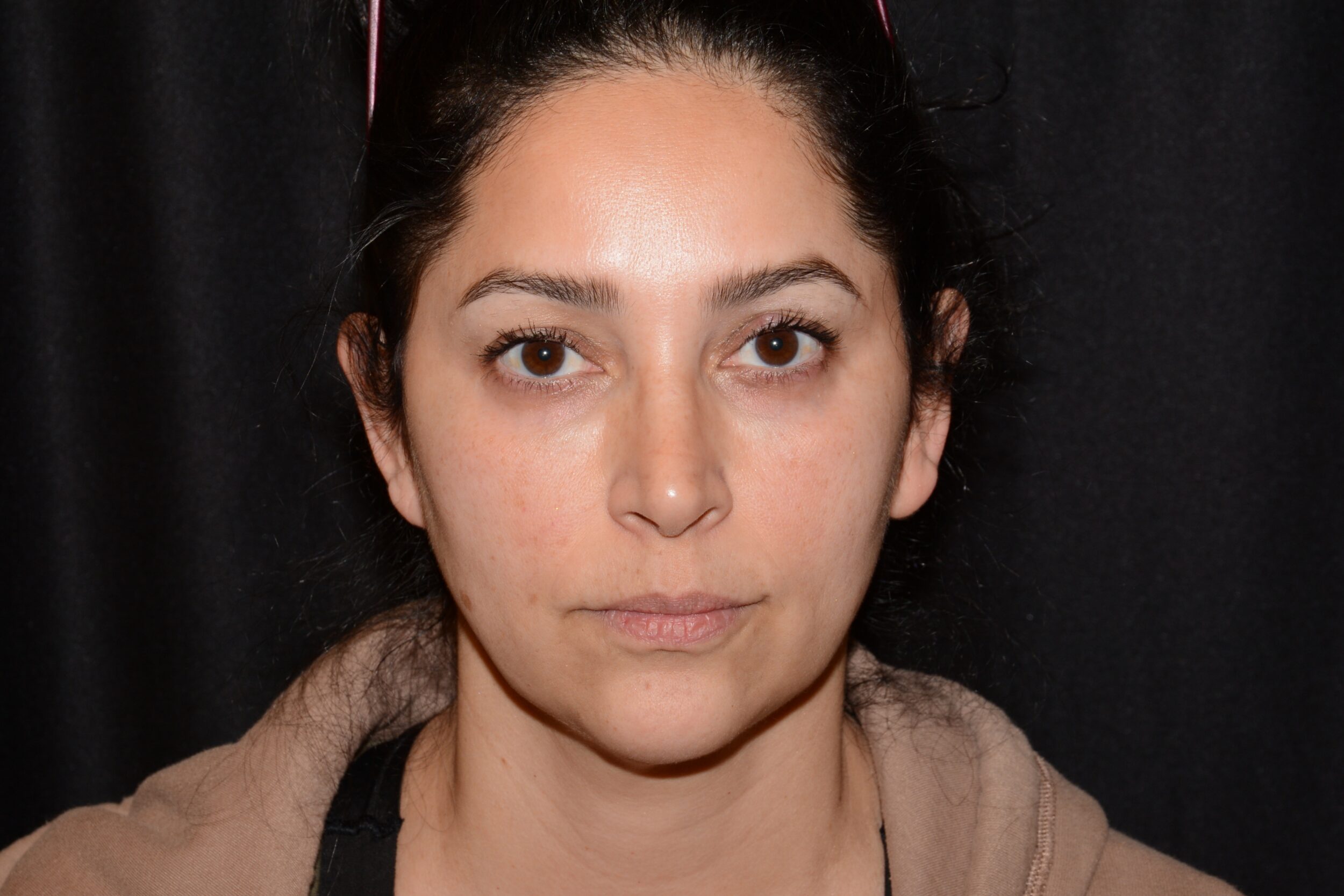 After Image: Eleven’s Forehead - front