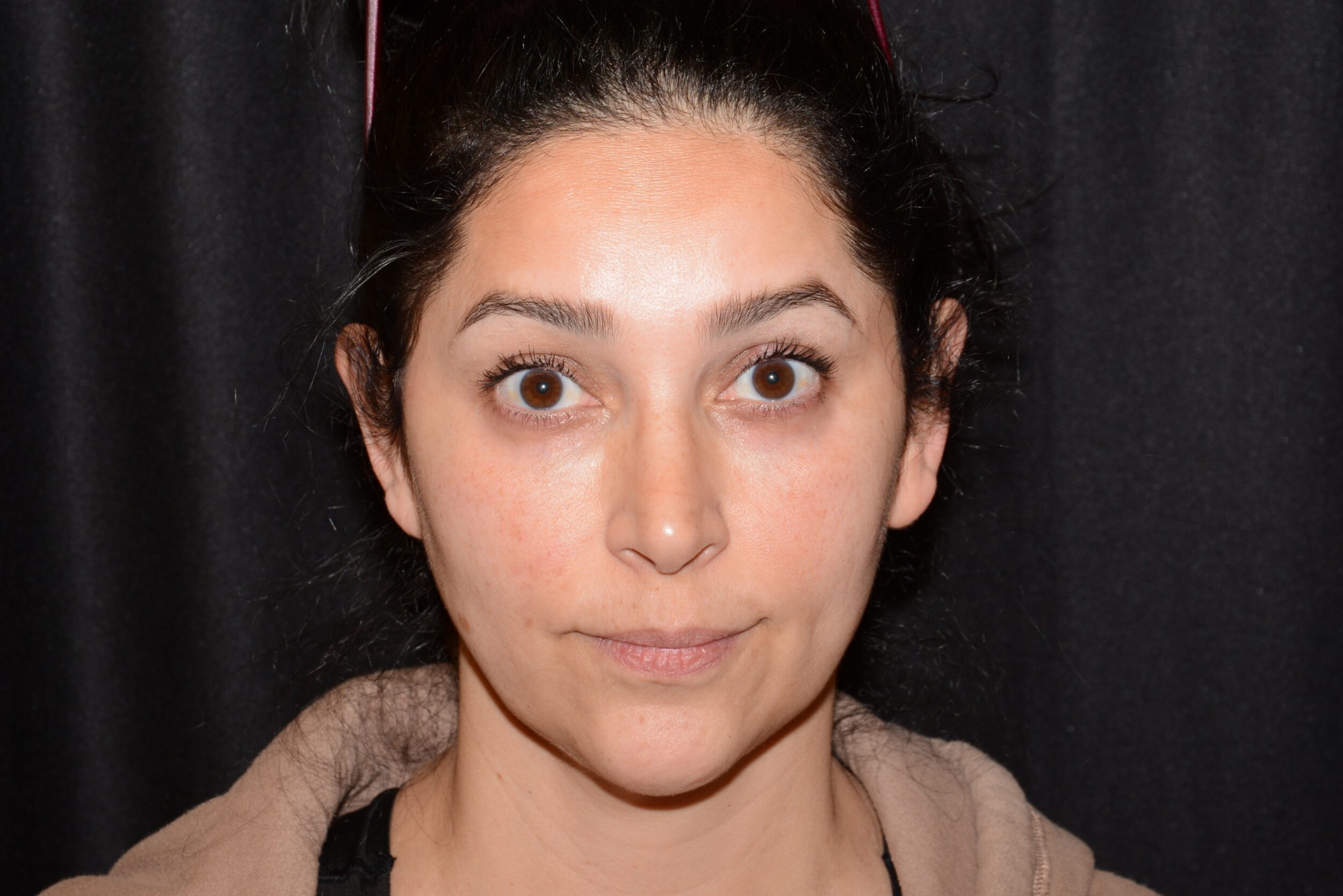 Strunkly Forehead Eleven's Forehead - Beverly Friedlander, MD