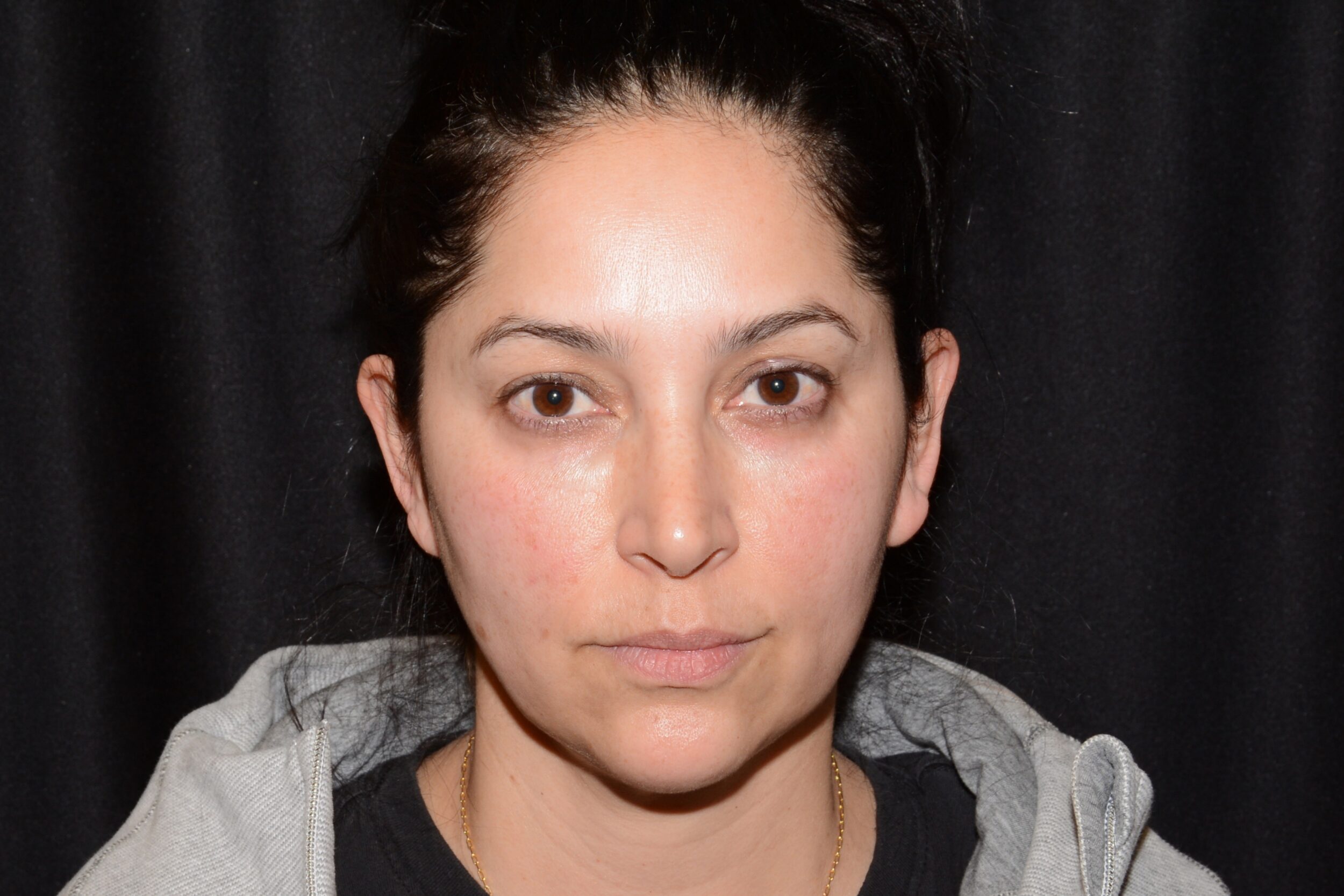 Before Image: Eleven’s Forehead - front