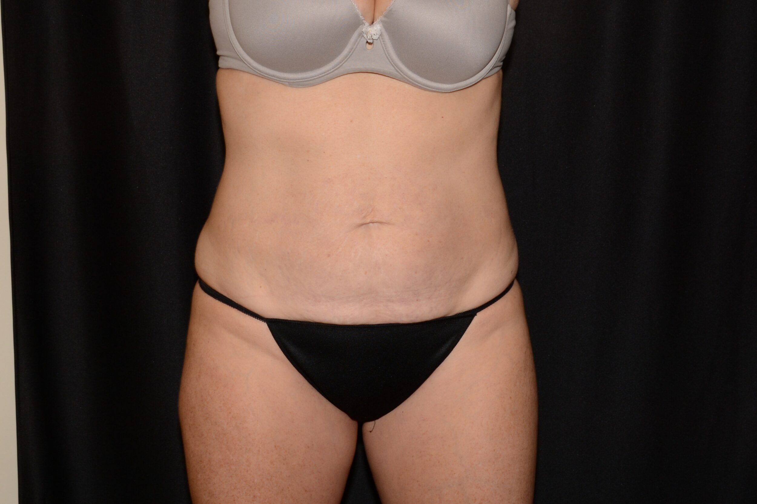 After Image: Morpheus  8 Body  and EMSculpt - front