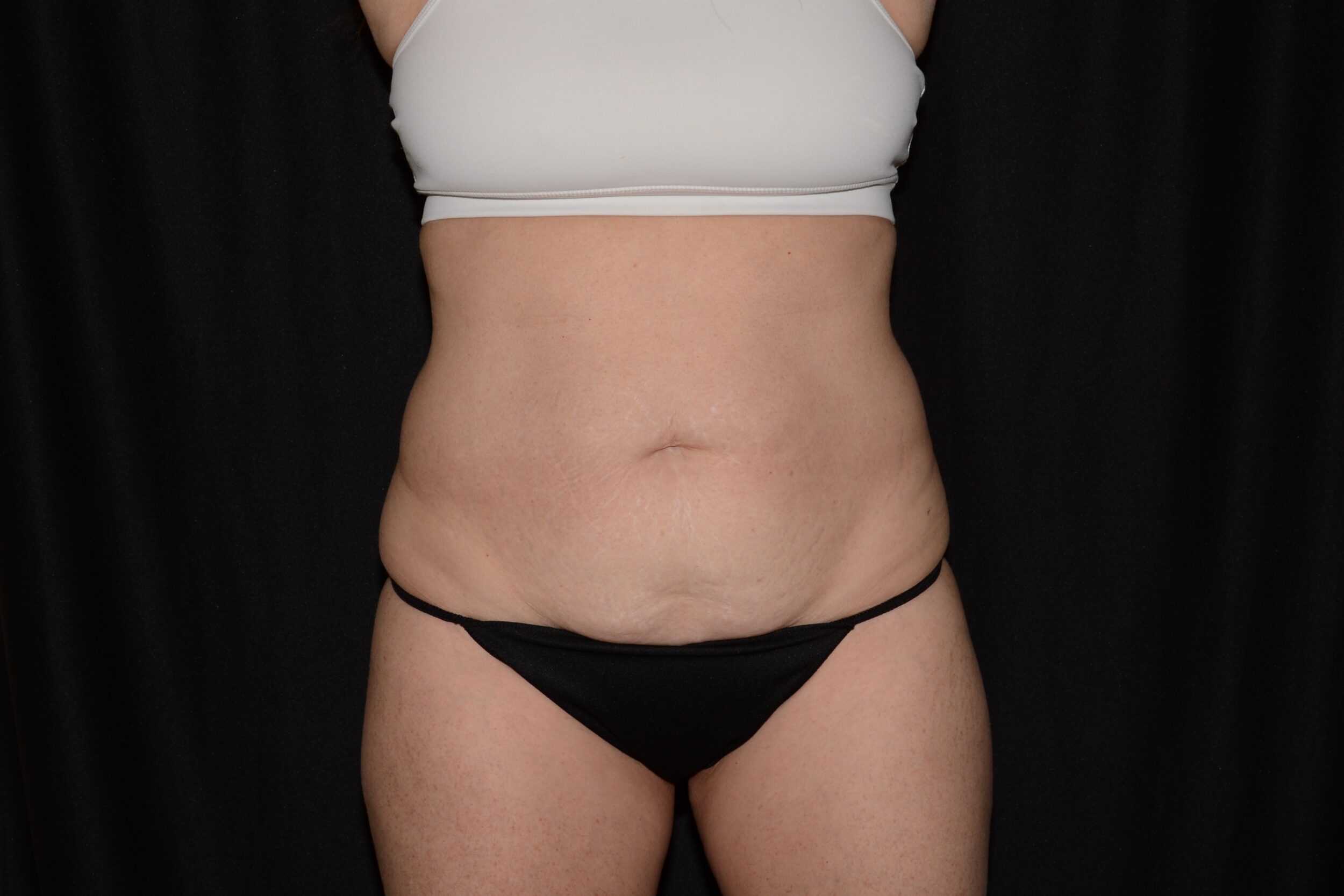 Before Image: Morpheus  8 Body  and EMSculpt - front