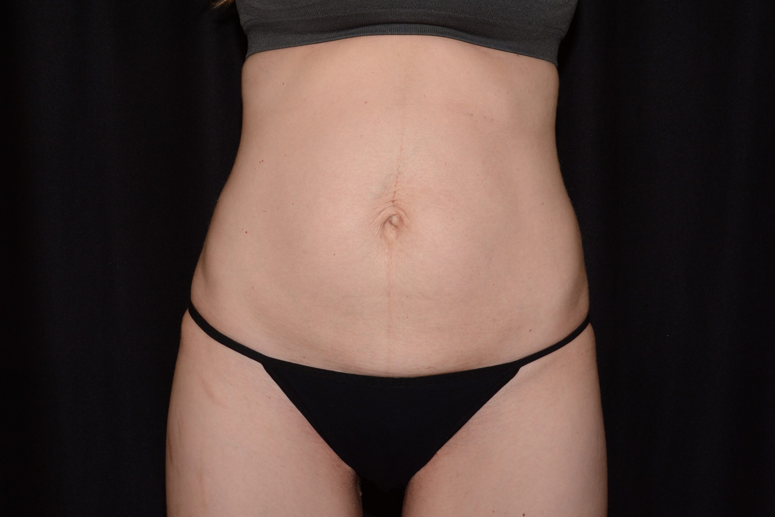 Before Image: EmsculptNeo and Morpheus8 Body - left-front-oblique