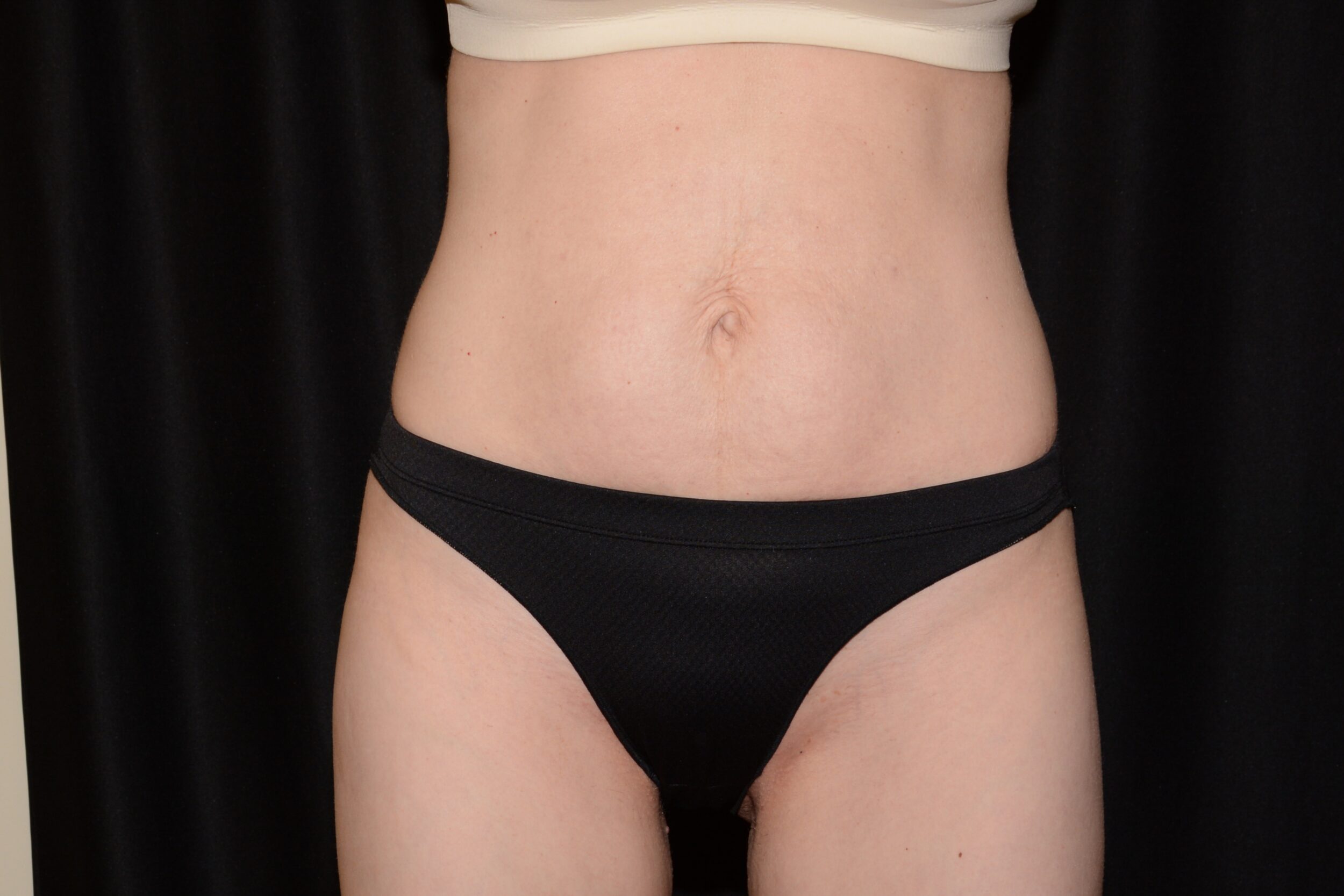 After Image: EmsculptNeo and Morpheus8 Body - left-front-oblique